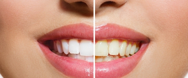 Your Smile Is Your Charm… Natural and Homemade Remedies to Restore the Brightness of Your Teeth Safely