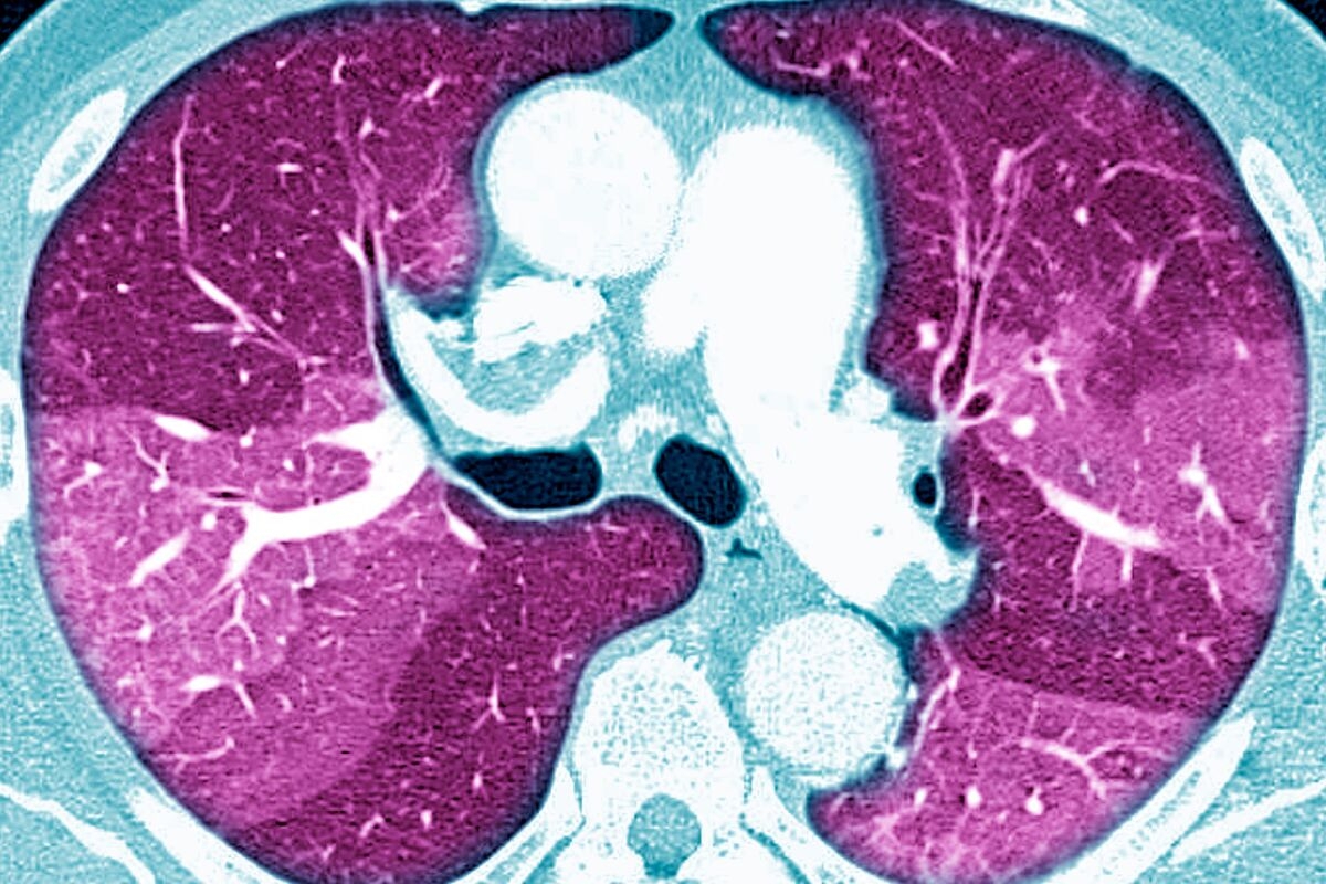 Boehringer Banks on New Lung Fibrosis Drug Being a Game Changer