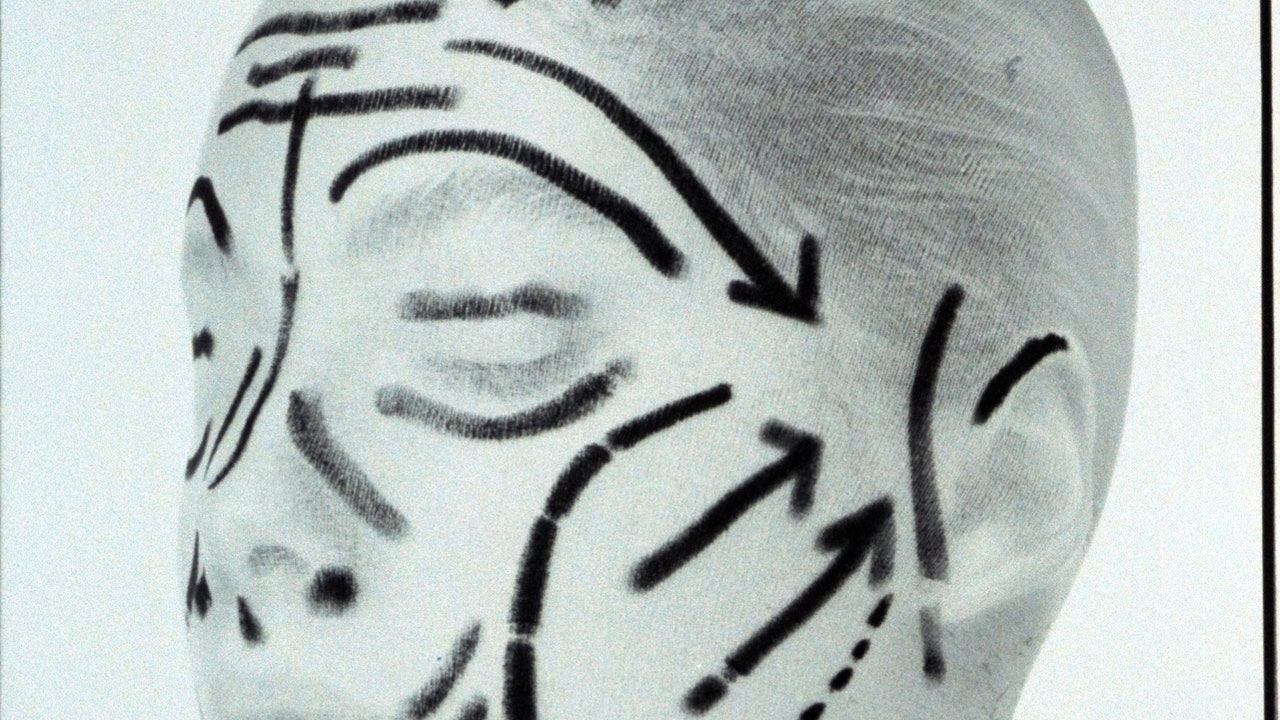 A Deep-Plane Facelift at 40: One Woman's Story