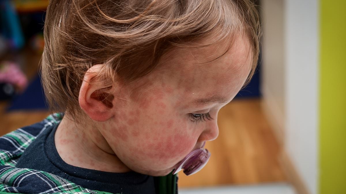 Nearly 200 students forced into quarantine after outbreak of measles on campus