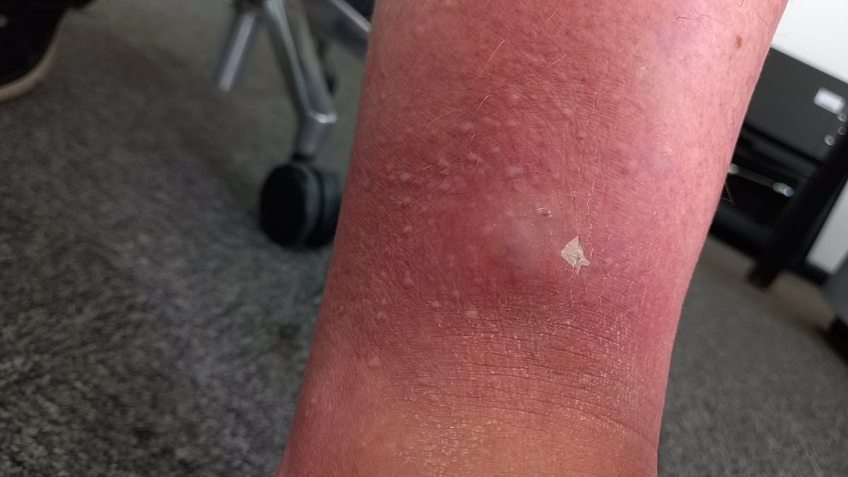 Britain's most dangerous spider strikes in Hertfordshire: Man is left in 'unbearable' pain and struggling to walk after bite from noble false widow