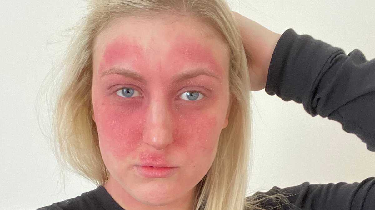 I thought I found the answer to my chronic eczema but the 'cure' from doctors gave me an even worse condition