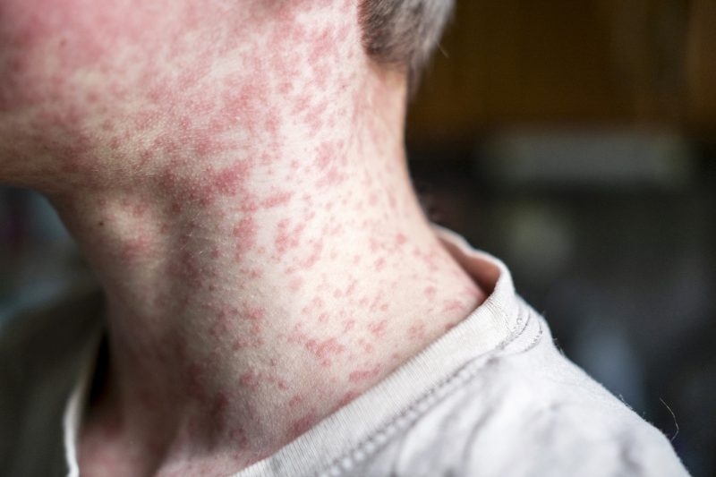 Possible measles exposure locations in Denver, Boulder after new confirmed case