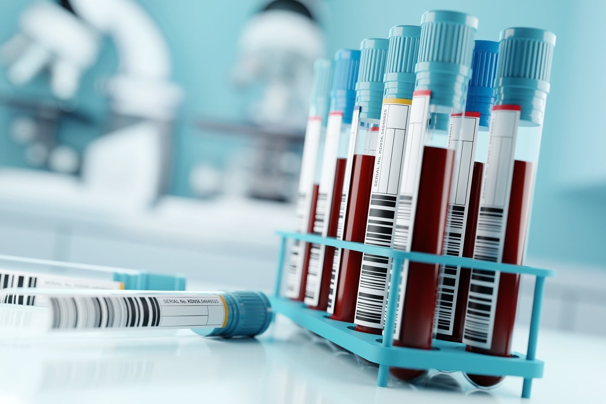 A simple blood test could offer first reliable diagnosis for ME