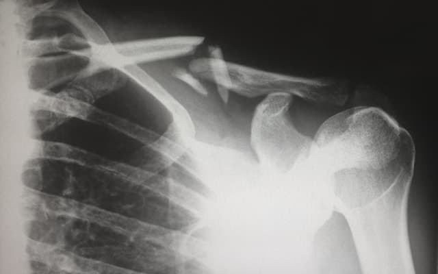 CRPS: Understanding & Managing Chronic Pain Early