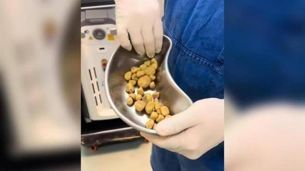 المشروبات الغازية أصابته بـ 35 حصوة كلوية