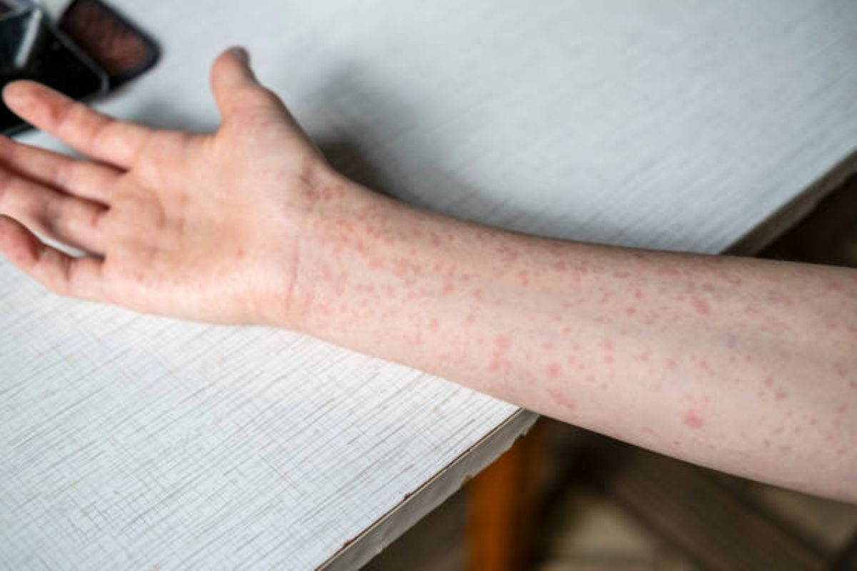 Gauteng rolls out mobile clinics to fight measles outbreak